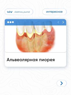 Альвеолярная пиорея: рекомендации профессора Лемецкой.